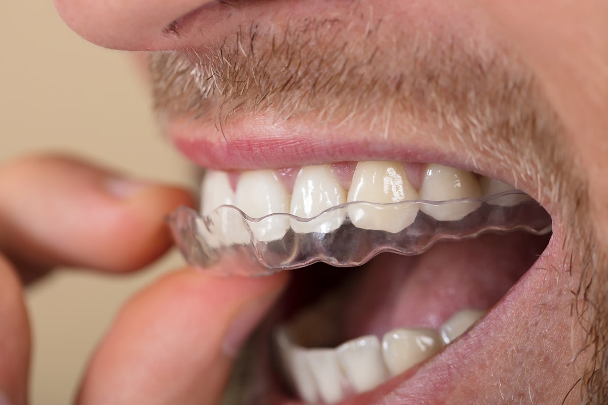 The Complete Guide To Taking Care of Invisalign Retainers