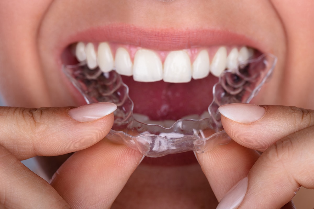 Navigating the Cost of Invisalign® Treatment