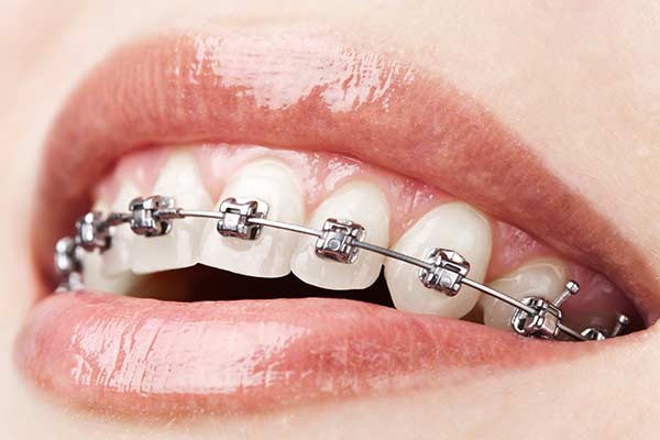 Traditional Metal Braces  Suffolk Pediatric Dentistry NY